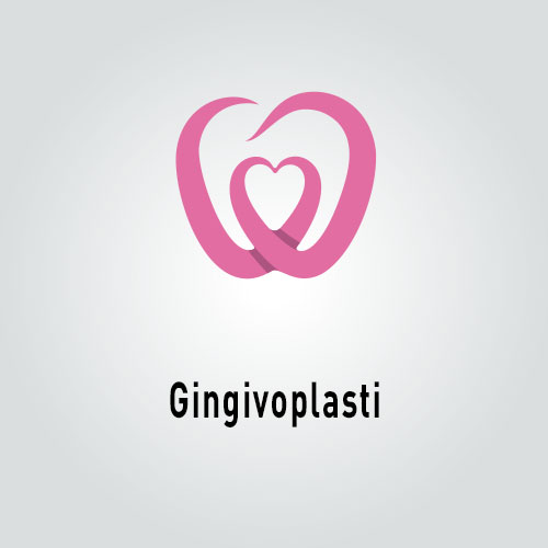 Gingivoplasti